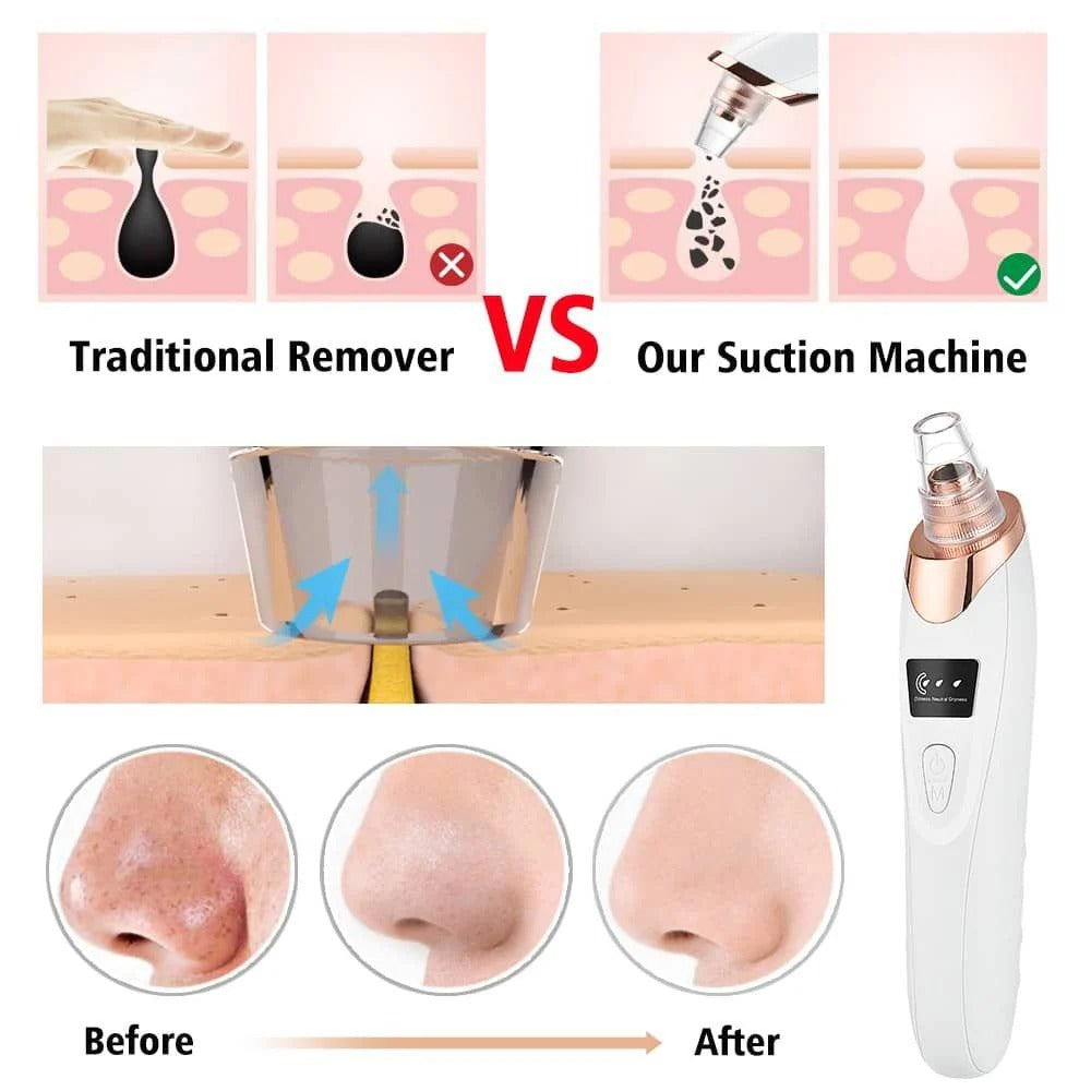 Electric Blackhead Remover – Deep Pore Cleaner